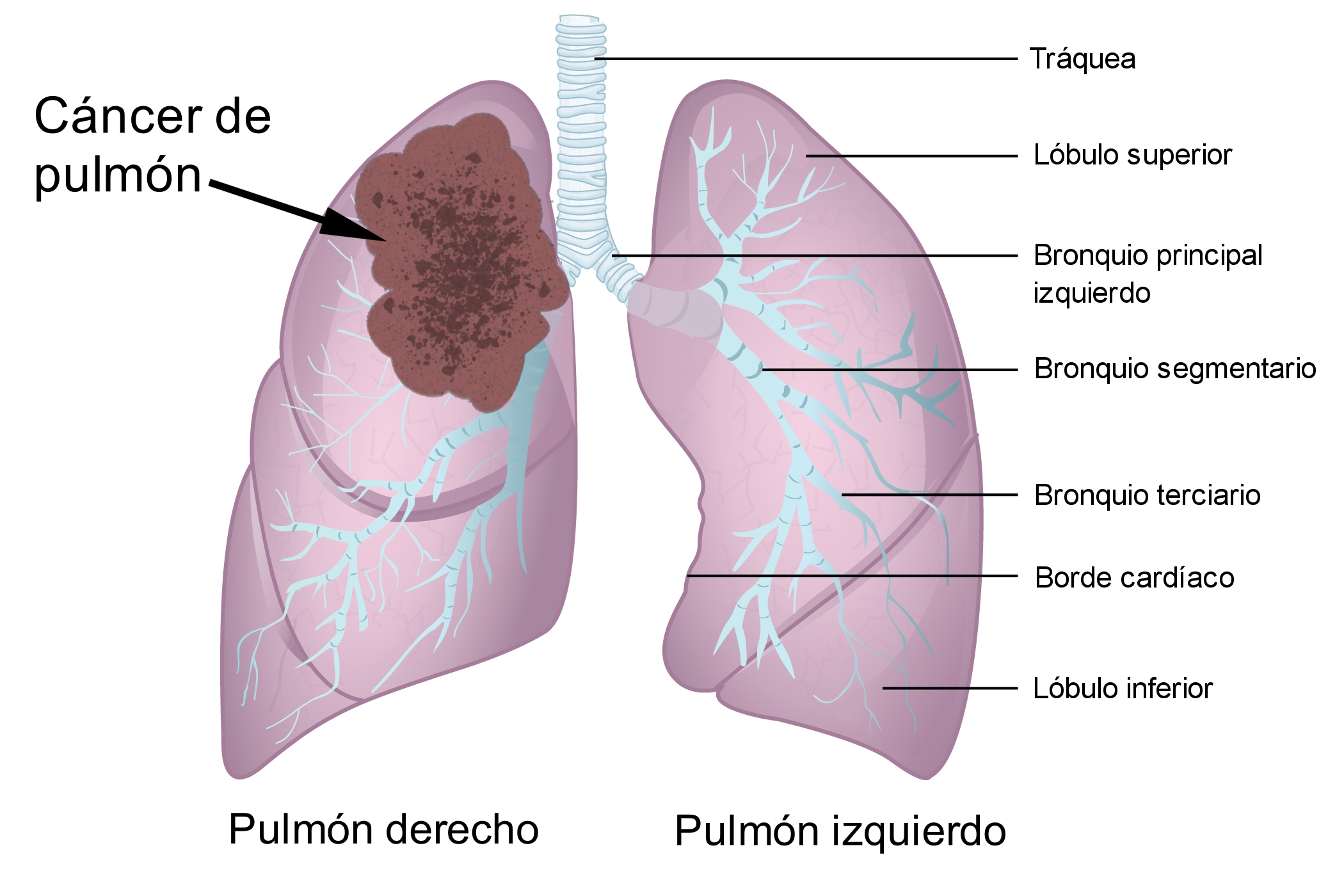 CANCER