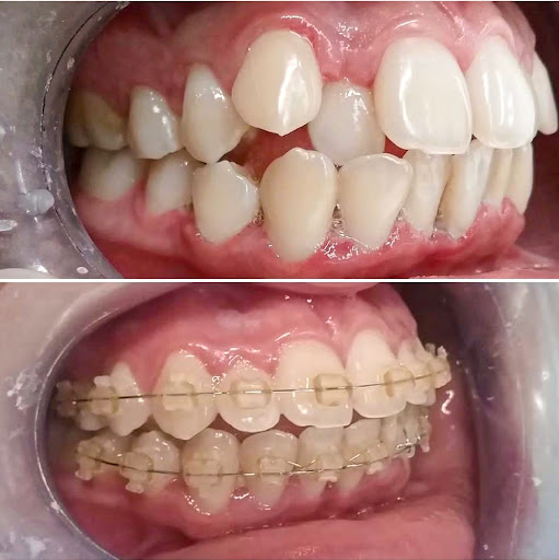 Brackets en el Agustino- Smile One