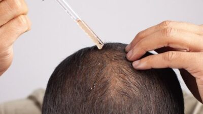 Clínicas de Caída del Cabello en Ancón