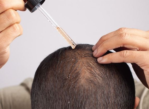 Clínicas de Caída del Cabello en Ancón