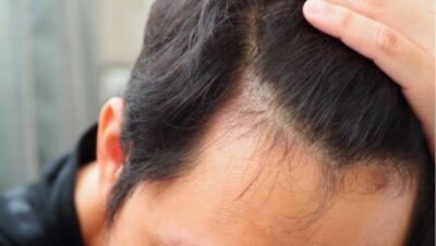 Clínicas de Caída del Cabello en Ate