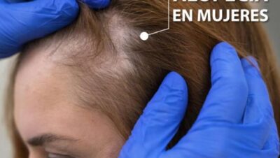 Clínicas de Caída del Cabello en Breña