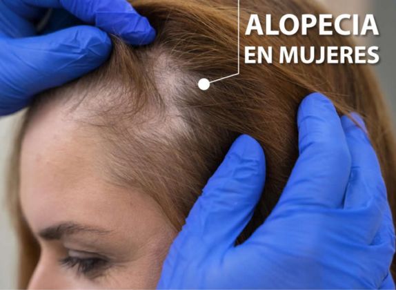 Clínicas de Caída del Cabello en Breña