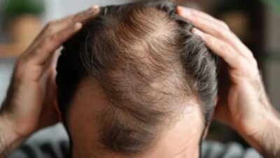 Clínicas de Caída del Cabello en Carabayllo
