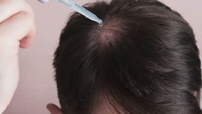 Clínicas de Caída del Cabello en Cercado de Lima