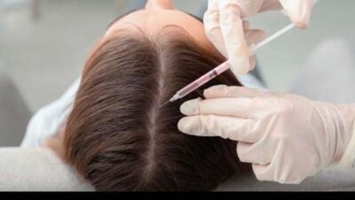 Clínicas de Caída del Cabello en Chaclacayo