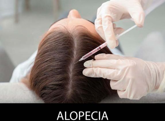 Clínicas de Caída del Cabello en Chaclacayo