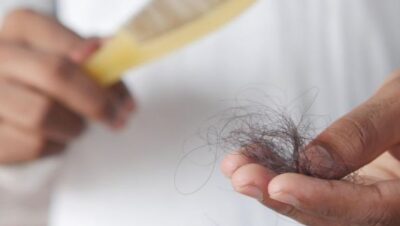 Clínicas de Caída del Cabello en La Victoria