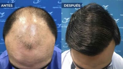 Clínicas de Caída del Cabello en Los Olivos