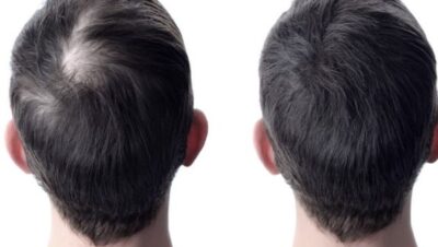 Clínicas de Caída del Cabello en Lurín