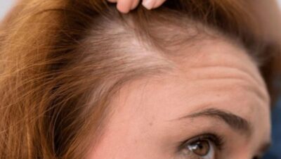 Clínicas de Caída del Cabello en Pachacámac