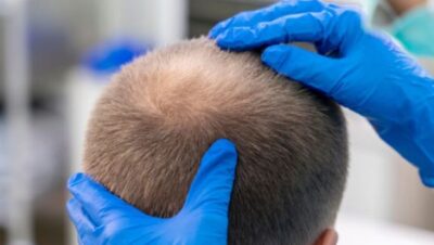 Clínicas de Caída del Cabello en Pucusana