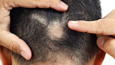 Clínicas de Caída del Cabello en Rímac