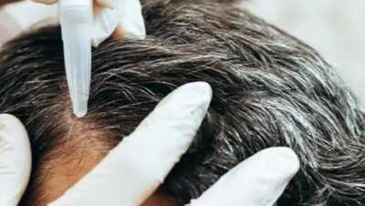 Clínicas de Caída del Cabello en San Isidro