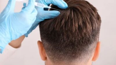 Clínicas de Caída del Cabello en San Juan de Lurigancho