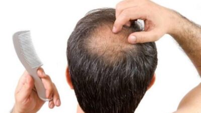 Clínicas de Caída del Cabello en San Martín de Porres