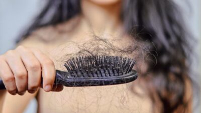 Clínicas de Caída del Cabello en Santiago de Surco