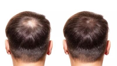 Clínicas de Caída del Cabello en Surquillo