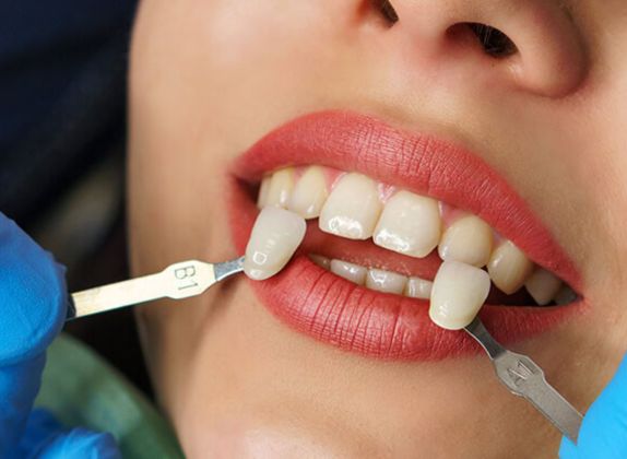 Clínicas de Carillas Dentales en Chaclacayo