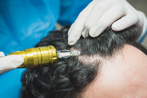 INJERTO CAPILAR ILEANOVO LIMA | IMPLANTE DE CABELLO ILEANOVO | TRASPLANTE CAPILAR ILEANOVO | INJERTO DE PELO