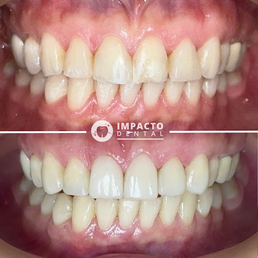 Impacto Dental Lima Cercado | Ortodoncia | Prótesis | Puentes de Porcelana