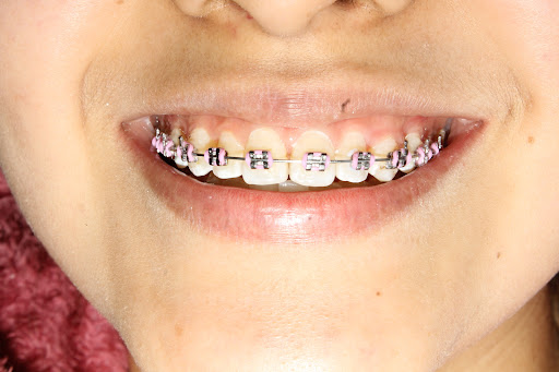 Chacla's Dent