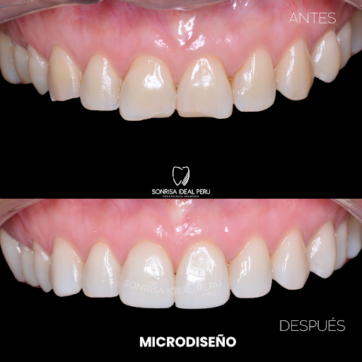 DISEÑO DE SONRISA LIMA