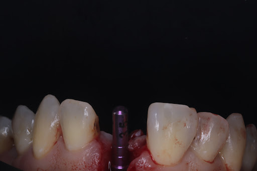 Mejor Clinica dental Elisseum - implantes dentales