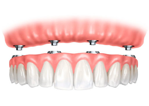 IMPLANTES DENTALES ESPECIALISTA RNE 3185