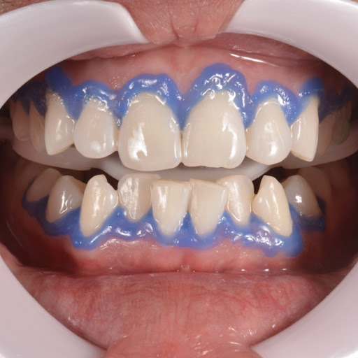 Dra Raquel Guerra|Dentista| Especialista Rehabilitación Oral| Prótesis dentales| Coronas | Carillas | Implantes | Curaciones