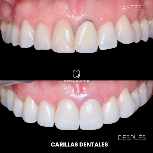 DISEÑO DE SONRISA LIMA