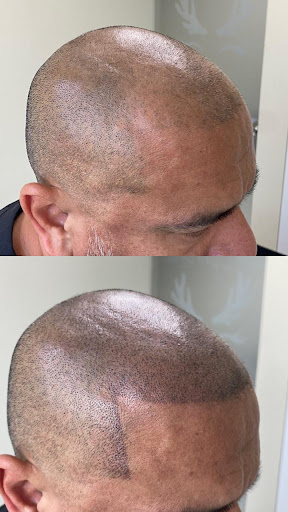 Micropigmentacion capilar Lima