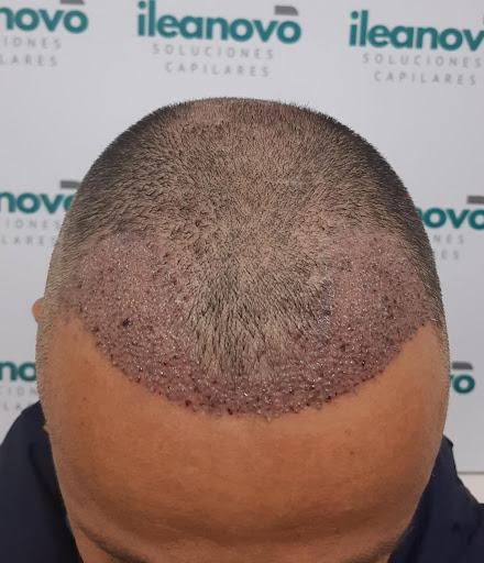 INJERTO CAPILAR ILEANOVO LIMA | IMPLANTE DE CABELLO ILEANOVO | TRASPLANTE CAPILAR ILEANOVO | INJERTO DE PELO