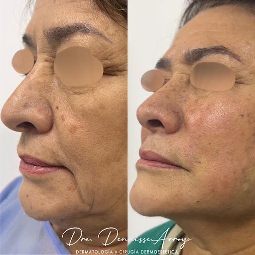 Dra. Dennisse Arroyo - Dermatología y Cirugía Dermoestética