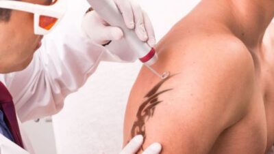 Clínicas de Eliminación de Tatuajes en Ancón