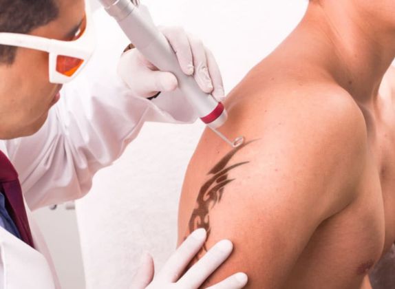 Clínicas de Eliminación de Tatuajes en Ancón