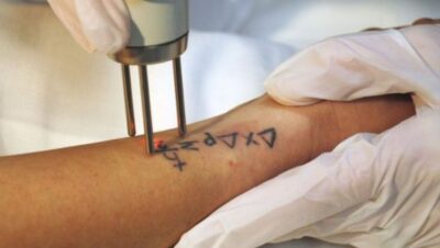 Clínicas de Eliminación de Tatuajes en Ate