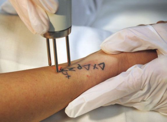 Clínicas de Eliminación de Tatuajes en Ate