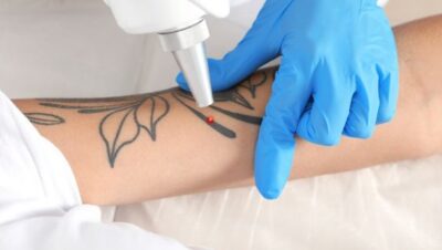 Clínicas de Eliminación de Tatuajes en Breña