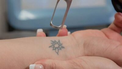 Clínicas de Eliminación de Tatuajes en Carabayllo
