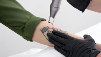 Clínicas de Eliminación de Tatuajes en Cercado de Lima