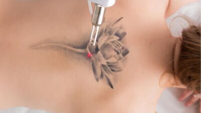 Clínicas de Eliminación de Tatuajes en Chorrillos