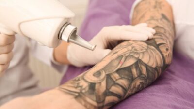 Clínicas de Eliminación de Tatuajes en Comas