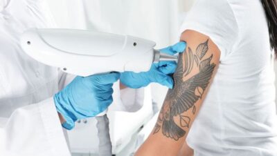 Clínicas de Eliminación de Tatuajes en El Agustino