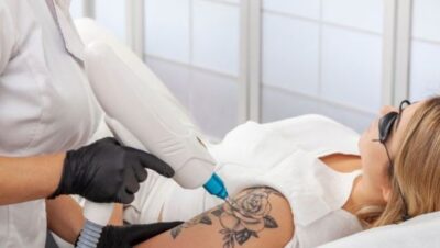 Clínicas de Eliminación de Tatuajes en Independencia