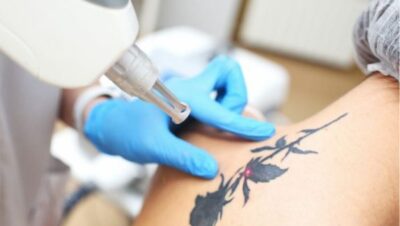 Clínicas de Eliminación de Tatuajes en Jesús María