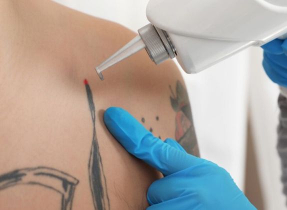 Clínicas de Eliminación de Tatuajes en La Victoria