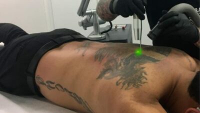 Clínicas de Eliminación de Tatuajes en Lurigancho (Chosica)
