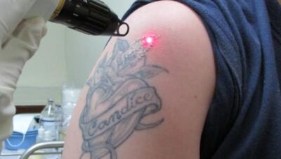 Clínicas de Eliminación de Tatuajes en Lurín