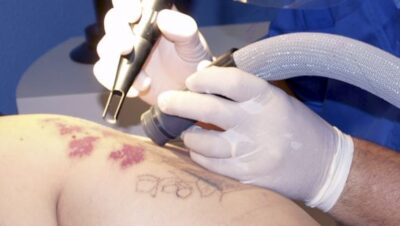 Clínicas de Eliminación de Tatuajes en Magdalena del Mar